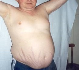 Синдром кушинга при раке легкого