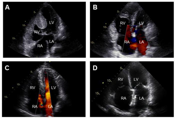 артериальная гипертензия клиника 