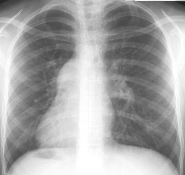 синдром артериальной гипертонии 