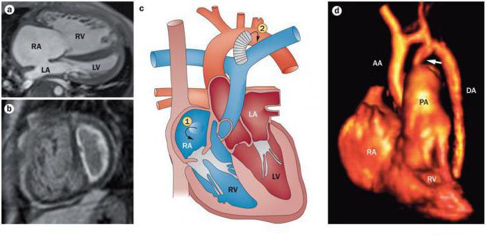 Синдром артериальной гипертензии