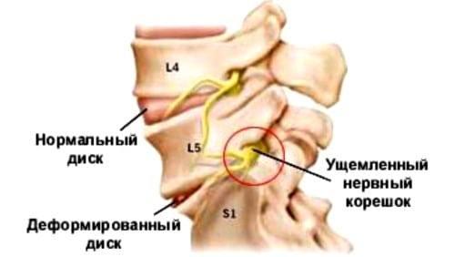 Что такое остеохондроз корешкового синдрома