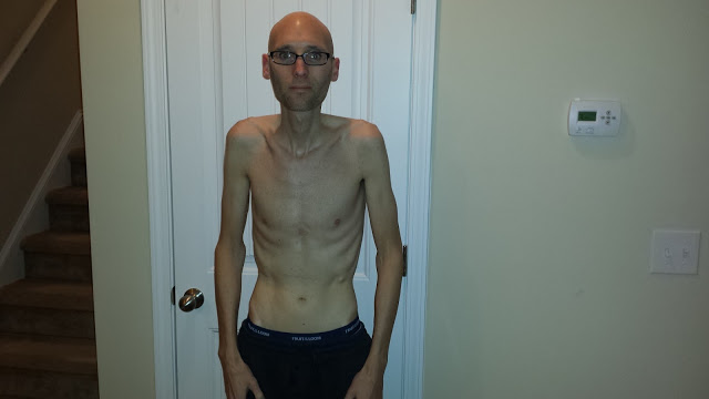 Синдром мальабсорбции у взрослых симптомы и лечение