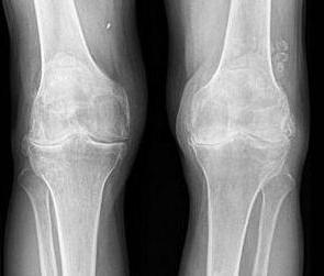 артроз коленного сустава