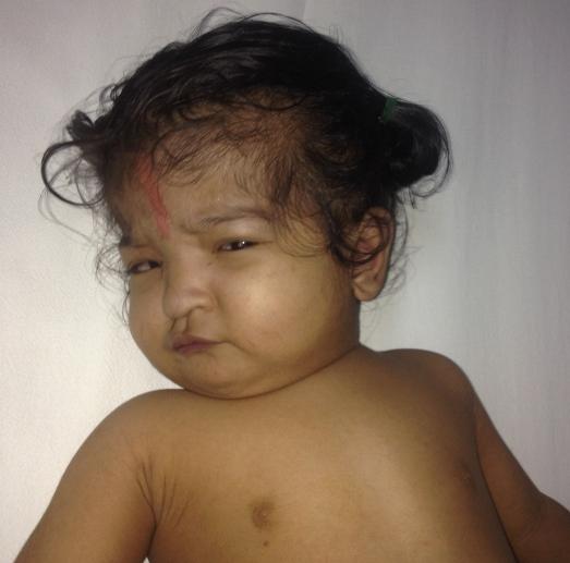 Девочка с пентасомией