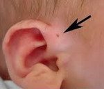 Околоушный свищ