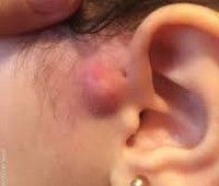 Околоушный свищ