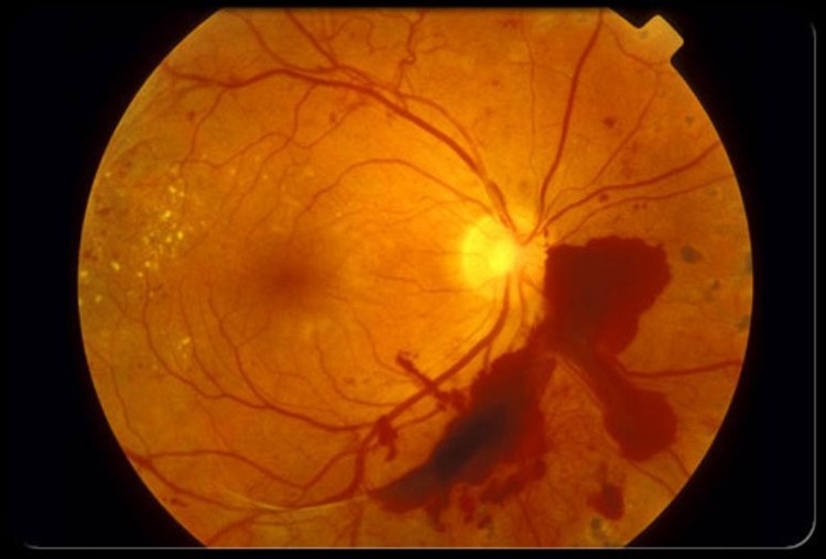 Диабетическая ангиопатия сетчатки и нижних конечностей: код по МКБ-10, симптомы и причины возникновения
