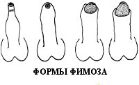 Фимоз