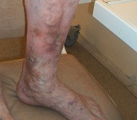 Хроническая венозная недостаточность