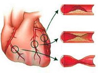 Ишемическая болезнь сердца