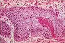 C15 Злокачественное новообразование пищевода