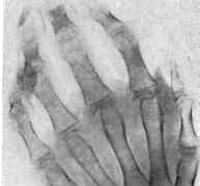 Болезнь Стилла