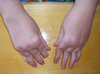 Хронический артрит