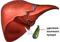 K91.5 Постхолецистэктомический синдром