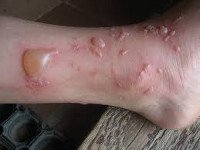 Ожоги у детей