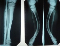 Фосфат-диабет