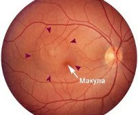 Центральная серозная хориоретинопатия