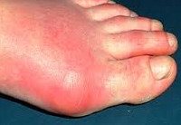 Артрит пальцев