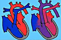 Транспозиция магистральных сосудов