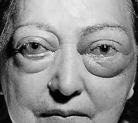 Эндокринная офтальмопатия