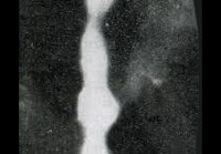 K22.4 Дискинезия пищевода