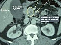 Доброкачественные опухоли поджелудочной железы