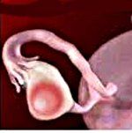 D27 Доброкачественное новообразование яичника