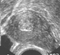 Плацентарный полип