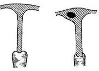 Q51.0 Агенезия и аплазия матки