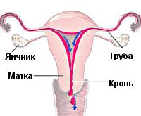 Вторичная аменорея