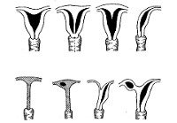 Аномалии развития матки
