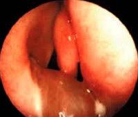 Хоанальный полип