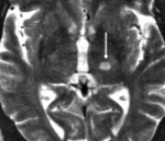 I63.9 Инфаркт мозга неуточненный