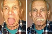 Прогрессирующий бульбарный паралич