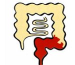 Ректосигмоидит