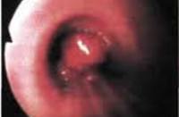 Опухоли бронхов