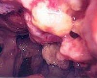 Доброкачественные опухоли плевры