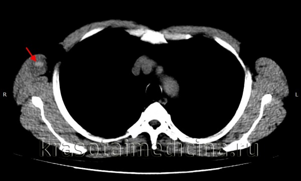 Гематома мягких тканей