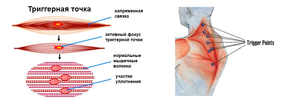 Триггерные точки и нормальные мышечные волокна