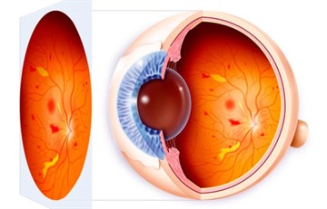 Диабетическая ангиопатия сетчатки и нижних конечностей: код по МКБ-10, симптомы и причины возникновения