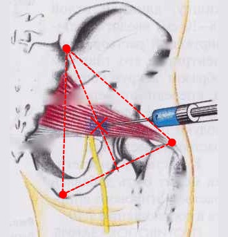 При наличии сильной боли возможно потребуется применение обезболивающих инъекций