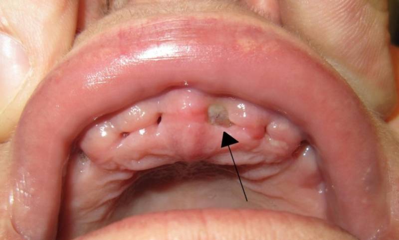 Альвеолит зуба