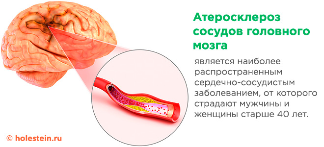 Атеросклероз сосудов головного мозга