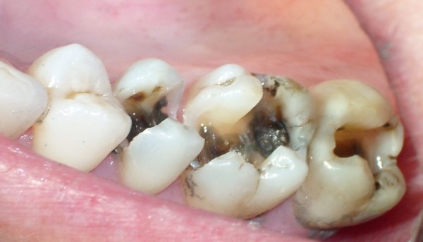 Классификация кариеса по мкб 10 виды поражений