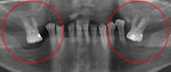Синдром попова годона