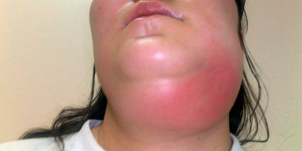 Флегмона челюстной части