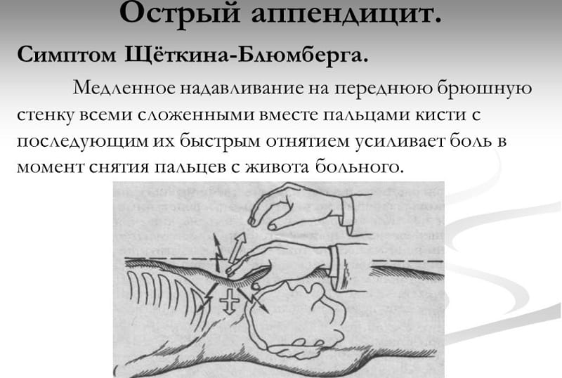 Как проявляются симптомы Щеткина — Блюмберга и Кохера — Волковича при аппендиците