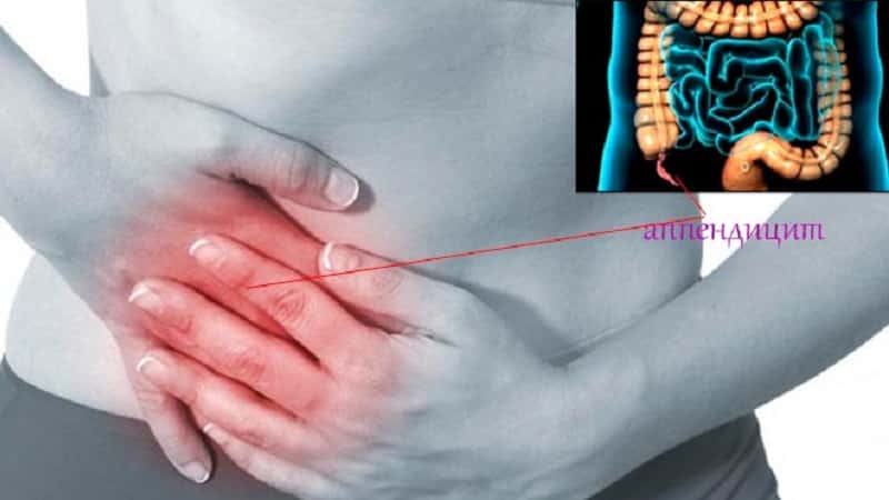 Как проявляются симптомы Щеткина — Блюмберга и Кохера — Волковича при аппендиците
