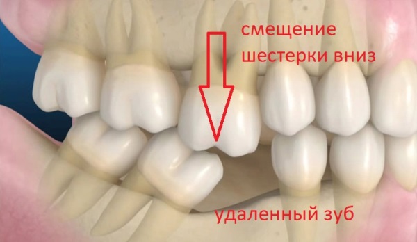 Как избежать развития феномена Попова Годона