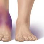 Хроническая венозная недостаточность код по МКБ 10: что это такое?